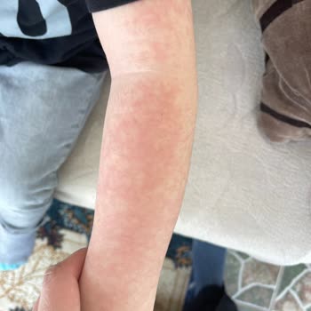 Argivit Classic Alerji Yaptı