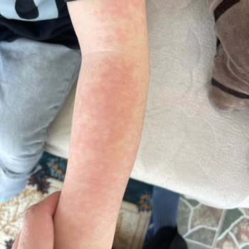 Argivit Classic Alerji Yaptı