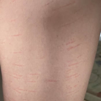 Alen Güzellik Ve Yaşam Merkezi'nde Yandım