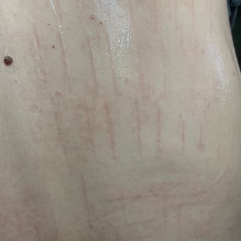 Alen Güzellik Ve Yaşam Merkezi'nde Yandım