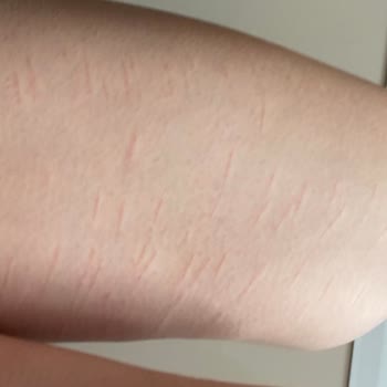 Alen Güzellik Ve Yaşam Merkezi'nde Yandım