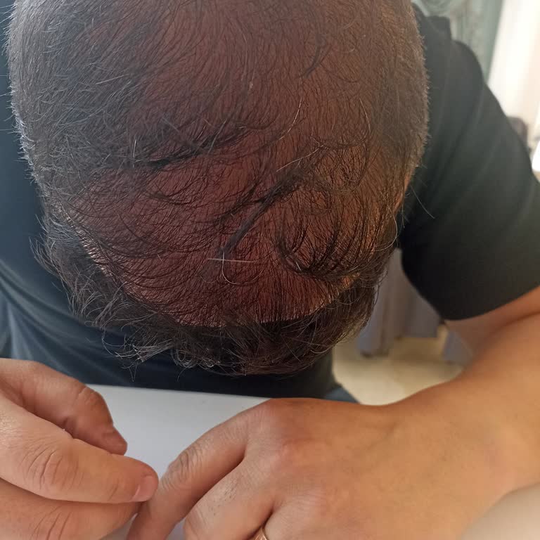 Aktif International Hospital Saç Ekimi Şikayet