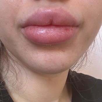 Regina Med Clinic Dudak Dolgusu Mağduriyeti