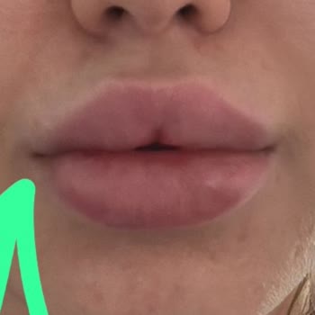 Regina Med Clinic Dudak Dolgusu Mağduriyeti