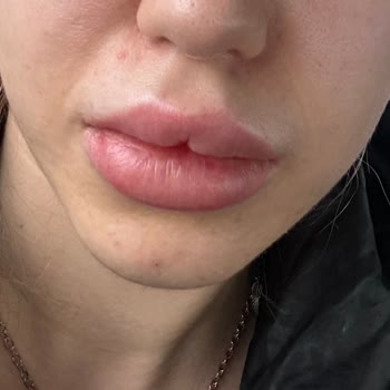 Regina Med Clinic Dudak Dolgusu Mağduriyeti