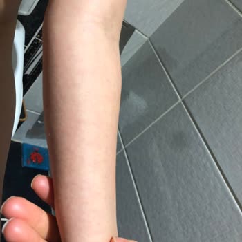 Bioderma Atoderm Baume Ürünleri Alerji Yapıyor