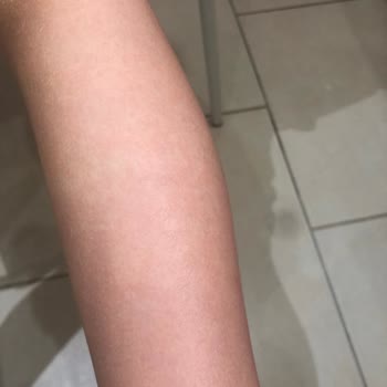 Bioderma Atoderm Baume Ürünleri Alerji Yapıyor