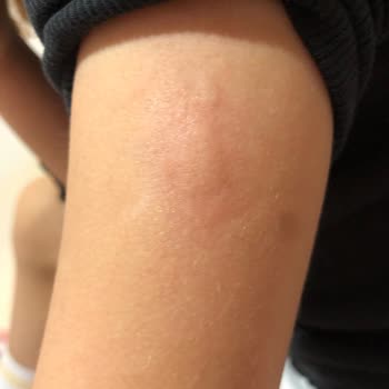 Bioderma Atoderm Baume Ürünleri Alerji Yapıyor