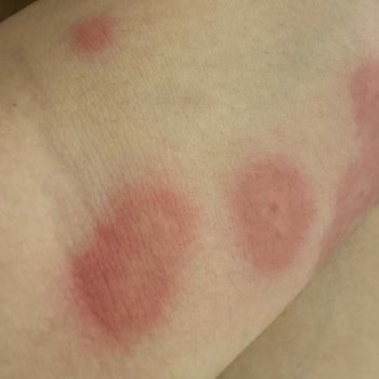 Zenhotels.com Sağlık Skandalı-tahtakurusu-zenhotels-edirne Antik Hotel