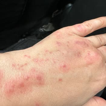 Zenhotels.com Sağlık Skandalı-tahtakurusu-zenhotels-edirne Antik Hotel