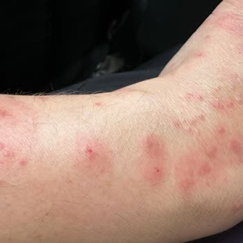 Zenhotels.com Sağlık Skandalı-tahtakurusu-zenhotels-edirne Antik Hotel