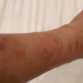 Zenhotels.com Sağlık Skandalı-tahtakurusu-zenhotels-edirne Antik Hotel