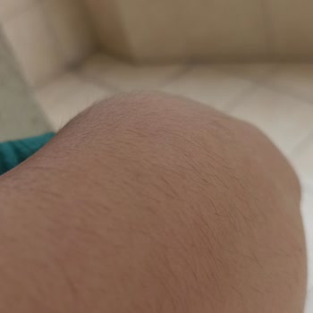 Dilan Polat Yalova Şubesi Lazer Epilasyon