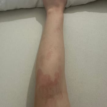 Novar Poliklinik Alsancak Novar'da Yaşanan Lazer Epilasyon Sıkıntısı