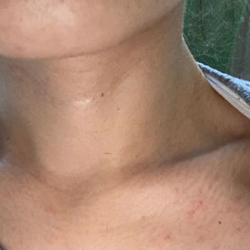 Loreal Paris 7 Günlük Kür Her Yerimi Alerji Yaptı