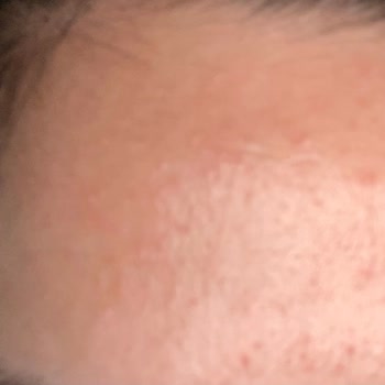 Loreal Paris 7 Günlük Kür Her Yerimi Alerji Yaptı