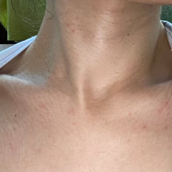 Loreal Paris 7 Günlük Kür Her Yerimi Alerji Yaptı