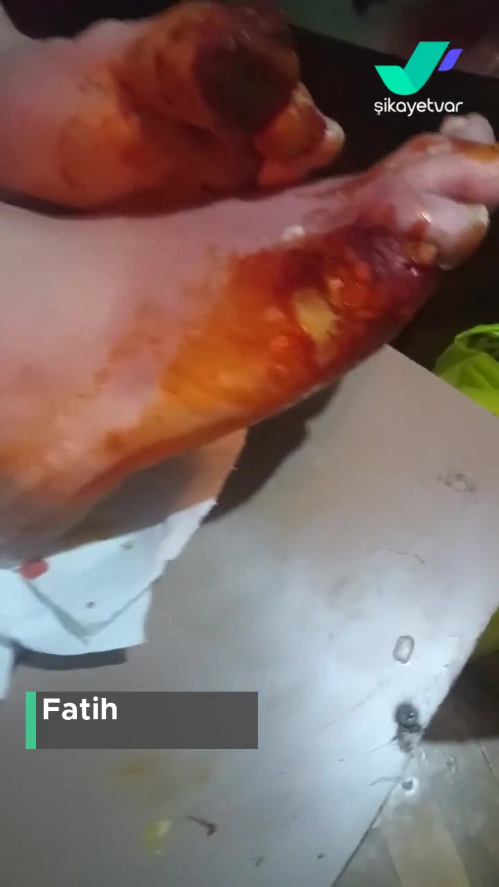 Tekirdağ Dr. İsmail Fehmi Cumalıoğlu Şehir Hastanesi Diyabet Ayak Tedavisi Yapacak Doktor Yok! videonun kapak resmi