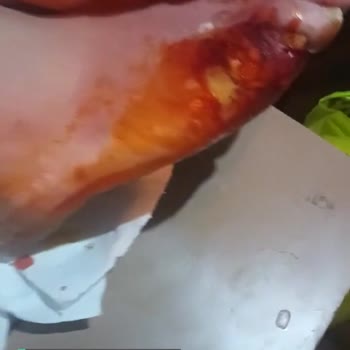 Tekirdağ Dr. İsmail Fehmi Cumalıoğlu Şehir Hastanesi Diyabet Ayak Tedavisi Yapacak Doktor Yok!