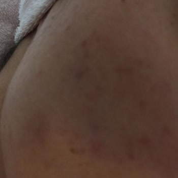 Bioderma Güneş Kremi Sivilce Yapıyor