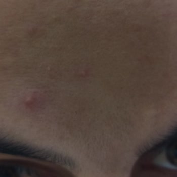 Bioderma Güneş Kremi Sivilce Yapıyor