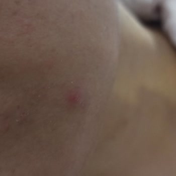 Bioderma Güneş Kremi Sivilce Yapıyor