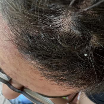 Head Shoulders Kepek Olmayan Saçımda Kepek Yaptı