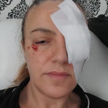 Samsun Eğitim Ve Araştırma Hastanesi Gözümdeki Kistler Ameliyat Olmama Rağmen Hala Duruyordu!