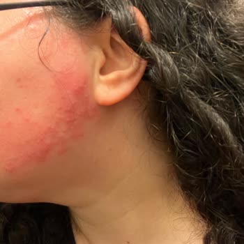 Gratis Beauty'de Kaş Ve Yüz Alımı Sonrası Sivilcelenme