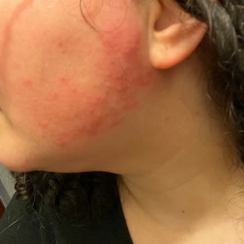 Gratis Beauty'de Kaş Ve Yüz Alımı Sonrası Sivilcelenme