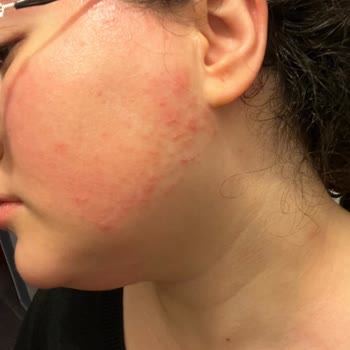 Gratis Beauty'de Kaş Ve Yüz Alımı Sonrası Sivilcelenme