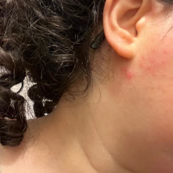 Gratis Beauty'de Kaş Ve Yüz Alımı Sonrası Sivilcelenme