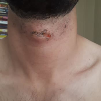 Trabzon Enza Güzellik Merkezi'nde Yaşanan Lazer Epilasyon Mağduriyeti