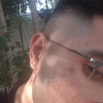 Trabzon Enza Güzellik Merkezi'nde Yaşanan Lazer Epilasyon Mağduriyeti