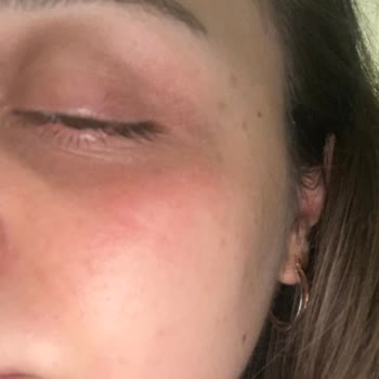 Yves Rocher Göz Altı Kremi Yüzümü Mahvetti