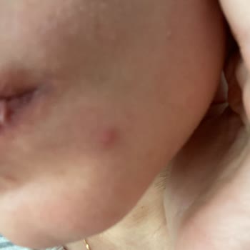 The Purest Solutions Güneş Kremi Sivilce Problemi