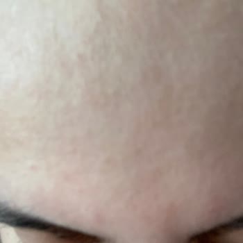 The Purest Solutions Güneş Kremi Sivilce Problemi