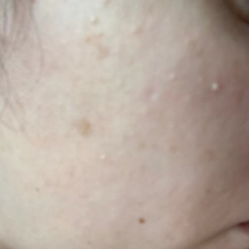 The Purest Solutions Güneş Kremi Sivilce Problemi