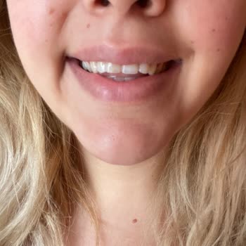 British Esthetic Diş Botoxu Yanağımın Simetrisini Bozdu Ve Etki Etmedi!