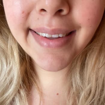 British Esthetic Diş Botoxu Yanağımın Simetrisini Bozdu Ve Etki Etmedi!