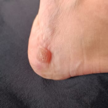 Asics Kayano 30 Heel Blister Issue during Running