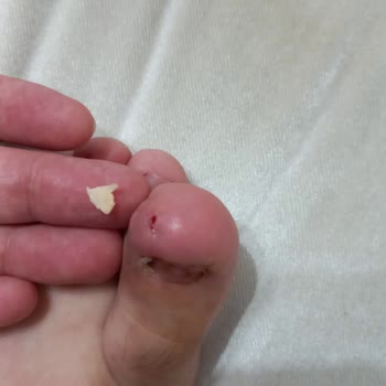 Yaşar Hastanesi Tırnak Çekimi Yapıldı