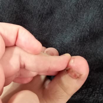 Yaşar Hastanesi Tırnak Çekimi Yapıldı