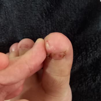 Yaşar Hastanesi Tırnak Çekimi Yapıldı