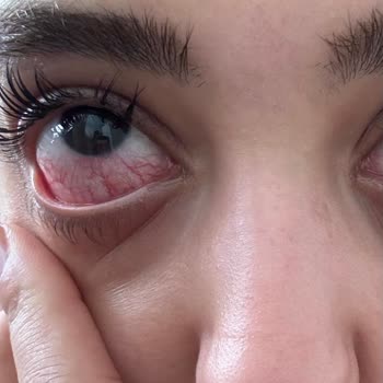 Bakırköy İpek Kirpik (By Selin Beauty) Kirpik Uygulamasında Yaşanan Sağlık Sorunları!