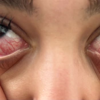 Bakırköy İpek Kirpik (By Selin Beauty) Kirpik Uygulamasında Yaşanan Sağlık Sorunları!