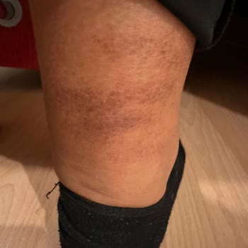 Suna Görer Güzellik Merkezi (Gebze) Lazer Epilasyon Hizmetinde Yaşanan Sorunlar Ve Müşteri Mağduriyeti