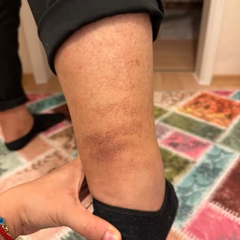 Suna Görer Güzellik Merkezi (Gebze) Lazer Epilasyon Hizmetinde Yaşanan Sorunlar Ve Müşteri Mağduriyeti