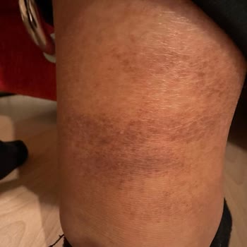 Suna Görer Güzellik Merkezi (Gebze) Lazer Epilasyon Hizmetinde Yaşanan Sorunlar Ve Müşteri Mağduriyeti