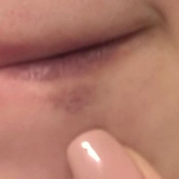 Didem Toktaş Beauty Güzellik Merkezinde Yaşanan Dudak Dolgusu Problemleri